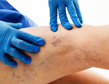 varicose veins in the legs